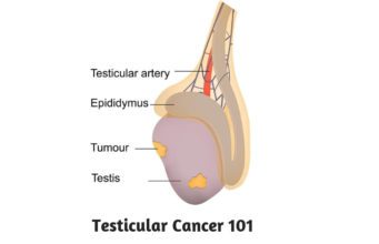 Testicular Cancer 101