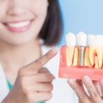 7 Important Reasons Why Dental Implants are the Best Choice for Replacing Missing Teeth